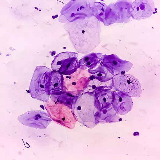 microscope image of cancer cells